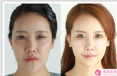 电动负压吸脂术脸部抽脂瘦脸整形手术危险吗