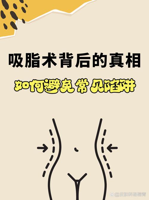 面部吸脂术会反弹吗_抽脂手术安全原则_共振抽脂优势