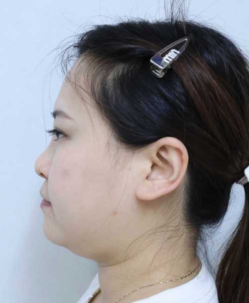 上饶面部微吸脂恢复期_面部微吸脂效果时间_面部吸脂术会反弹吗