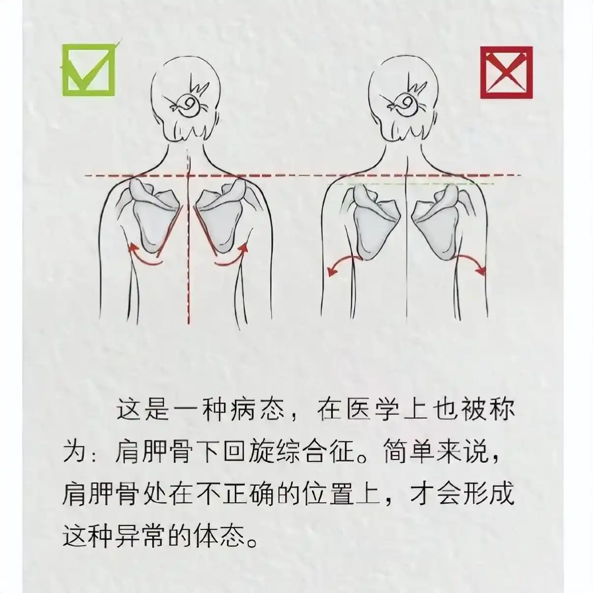 美人肩形态图解_直角肩审美误区_溜肩体态改善